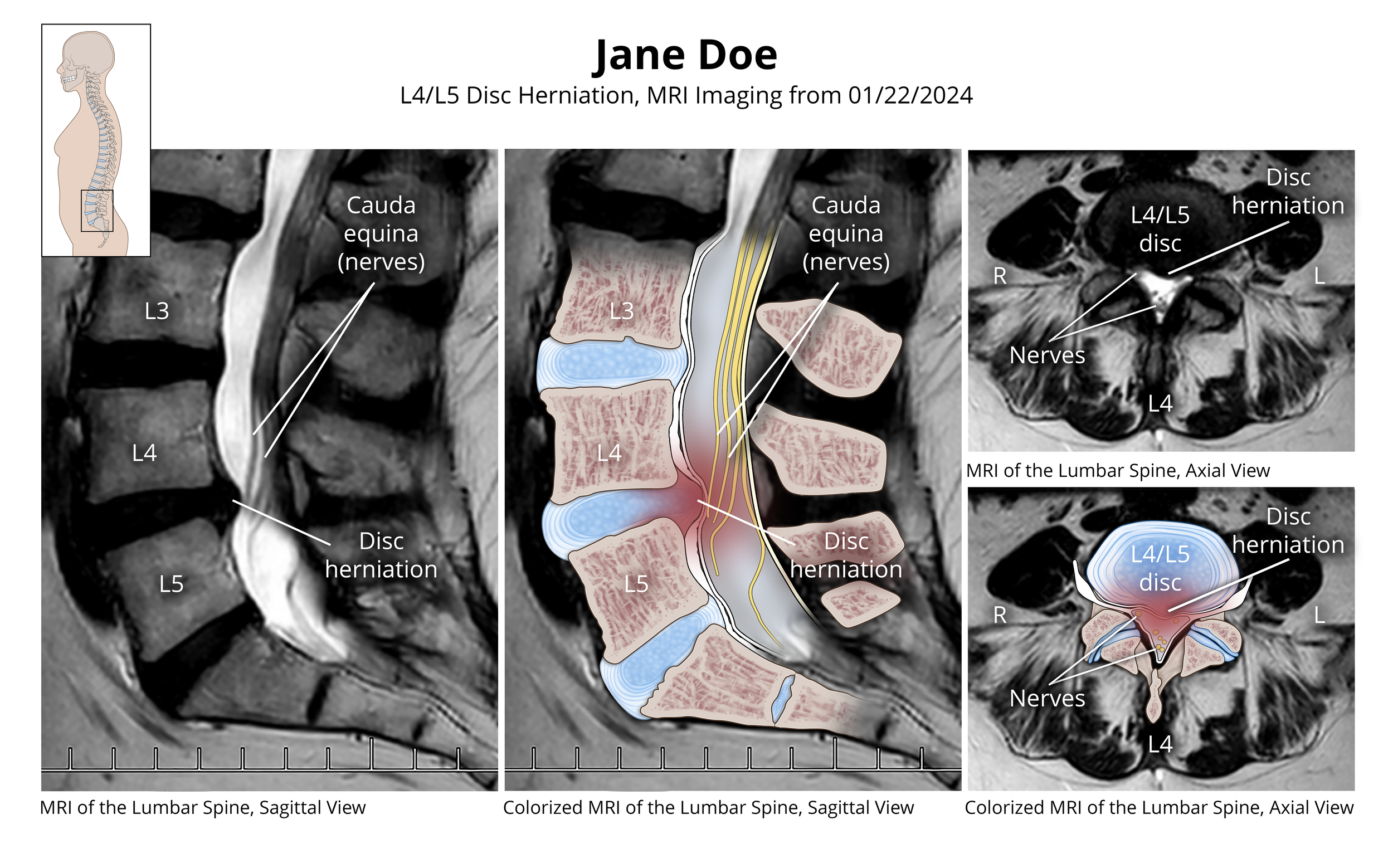  L4/L5 Disc Herniation 

 

 Overlaid Lumbar MRI demonstrating an L4/L5 herniation. 