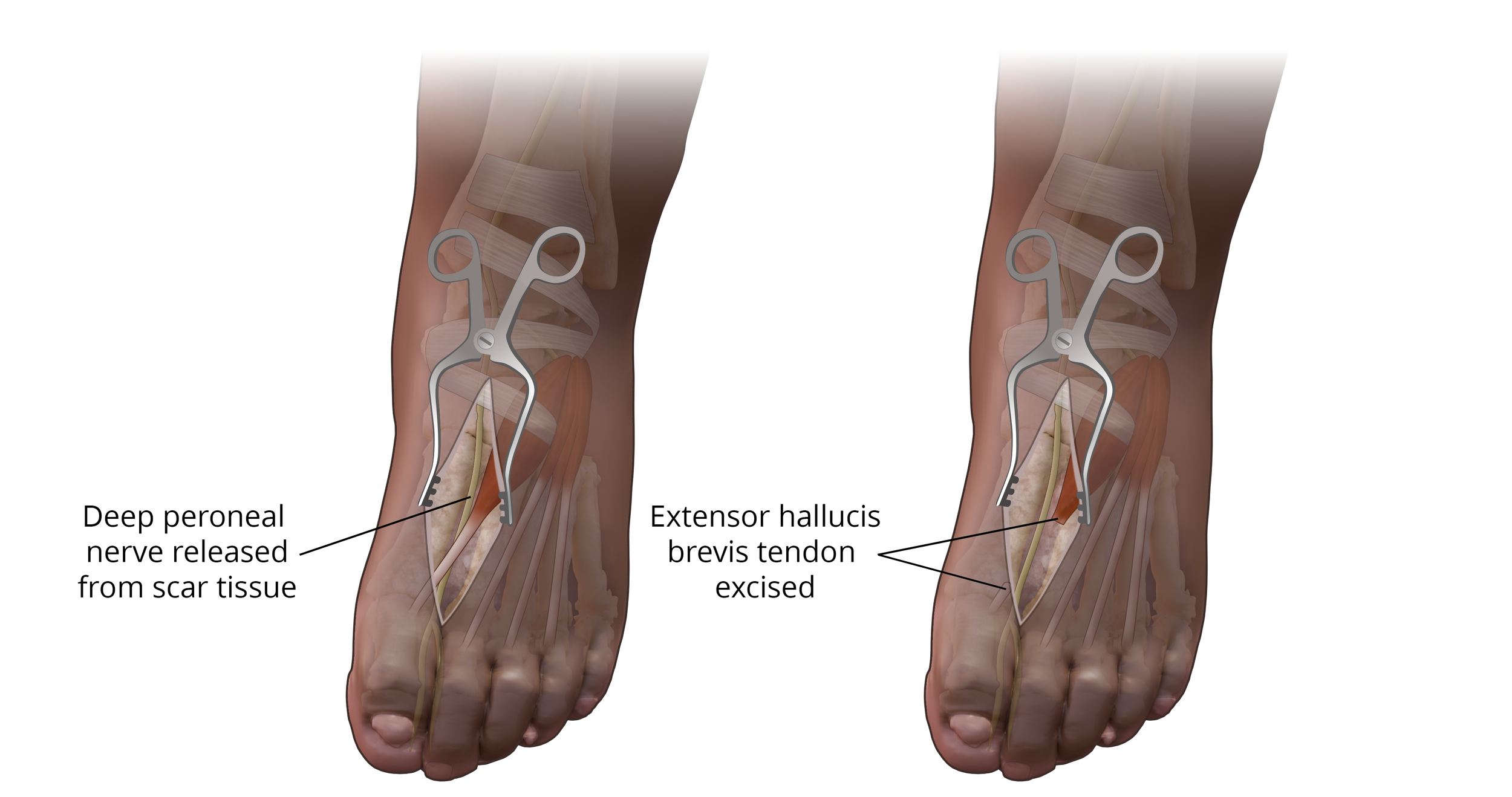  Deep Peroneal Nerve Release with Wrap 

 

 Deep peroneal nerve released and extensor hallucis brevis excised, created with CT data and Photoshop 
