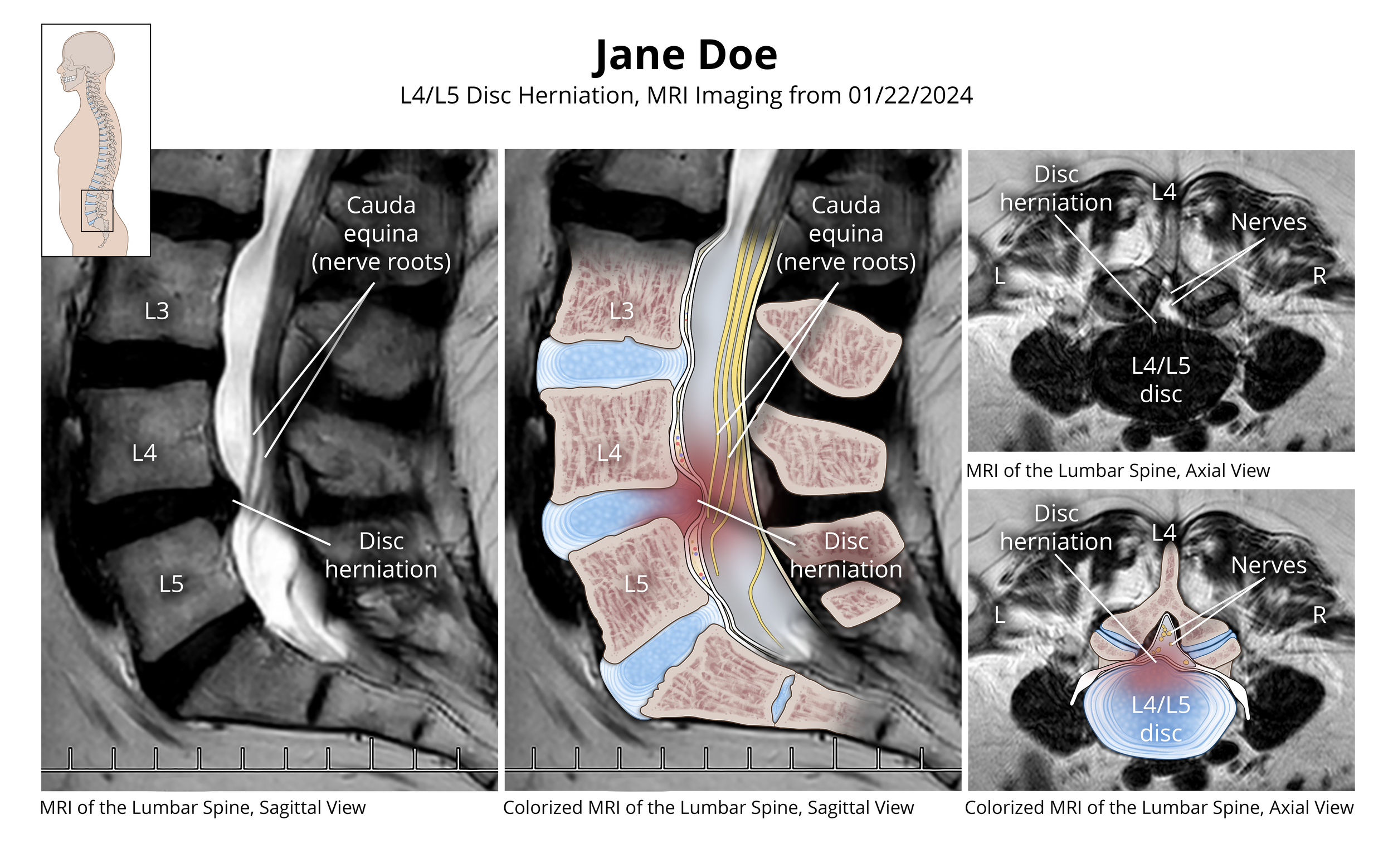 L4/L5 Disc Herniation 

 

 Overlaid Lumbar MRI demonstrating an L4/L5 herniation. 