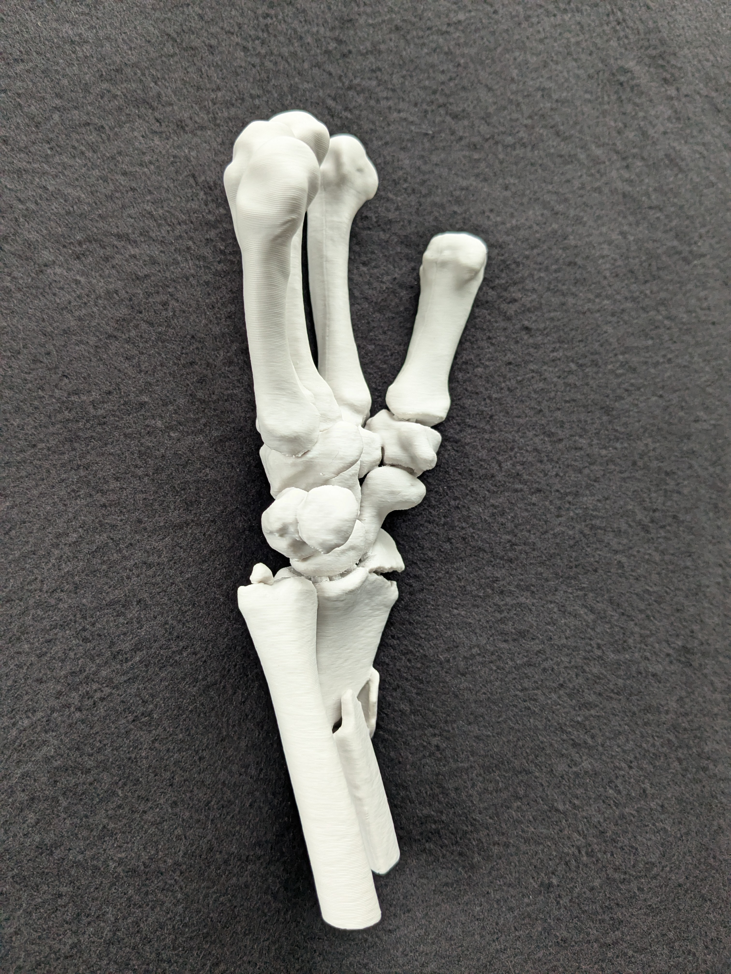  3D Printed Wrist Fracture 