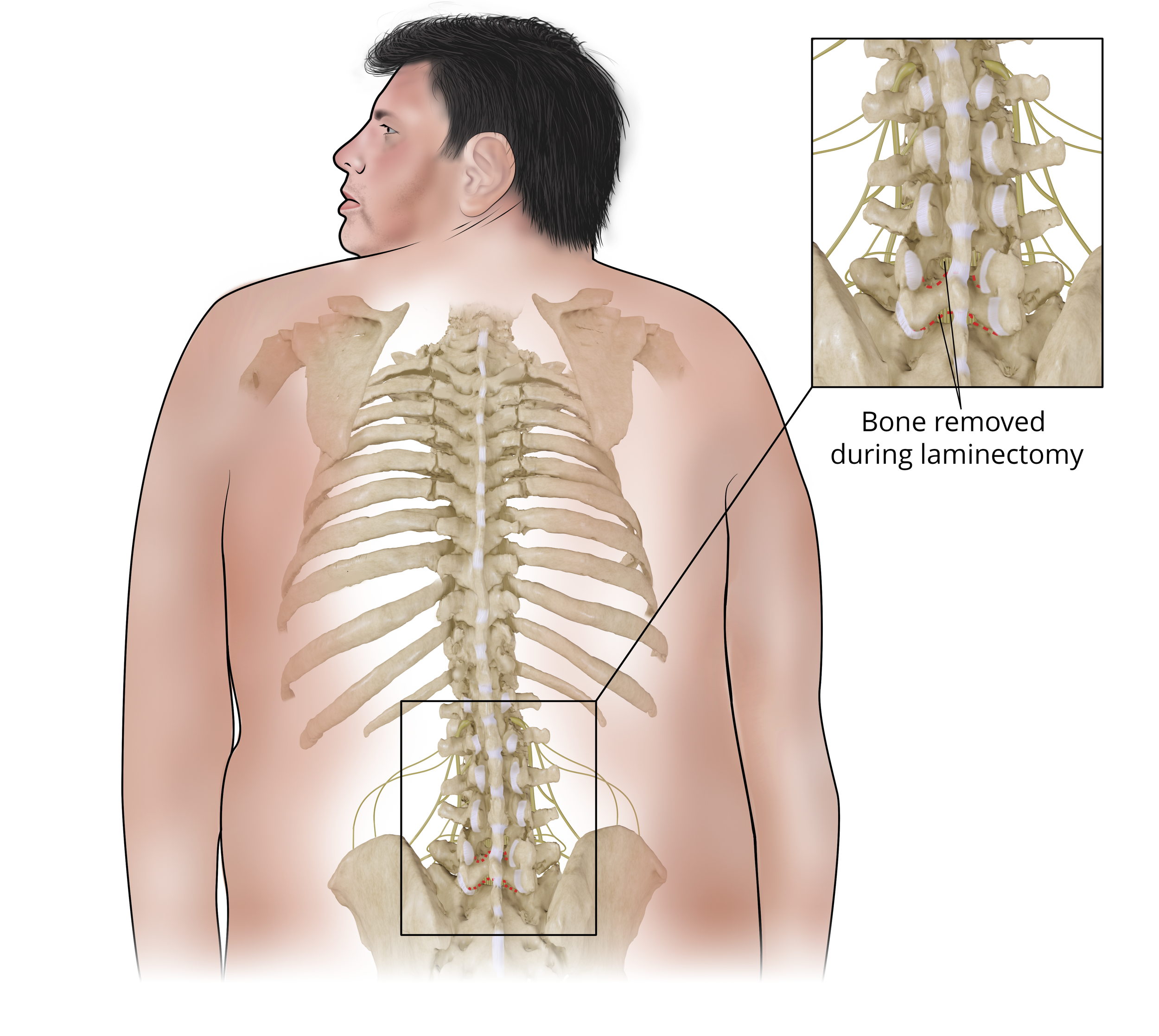  Healed Transverse Processes and Laminectomy 
