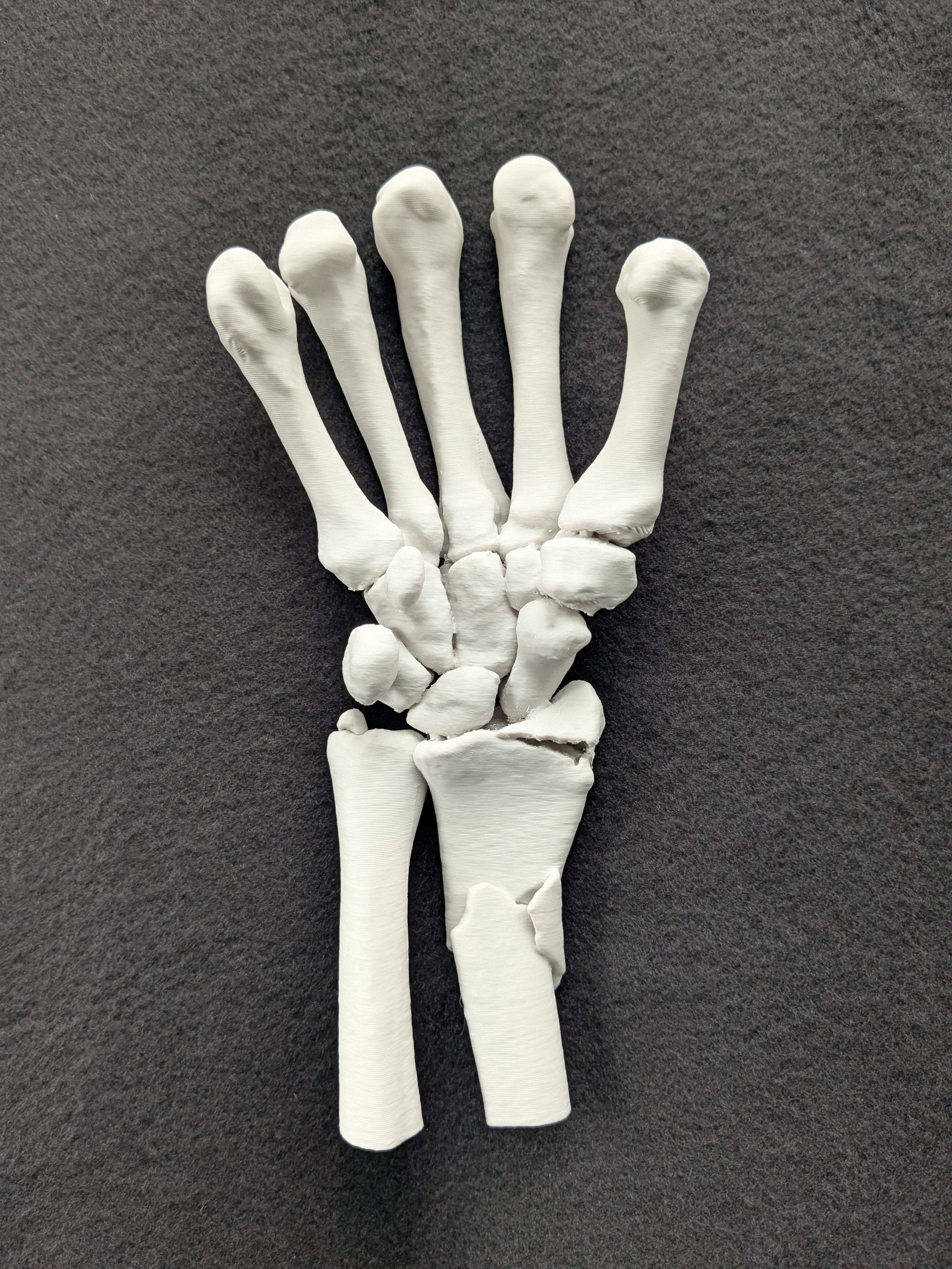 3D Printed Wrist Fracture 

 

 Wrist fracture 3D printed from patient imaging 
