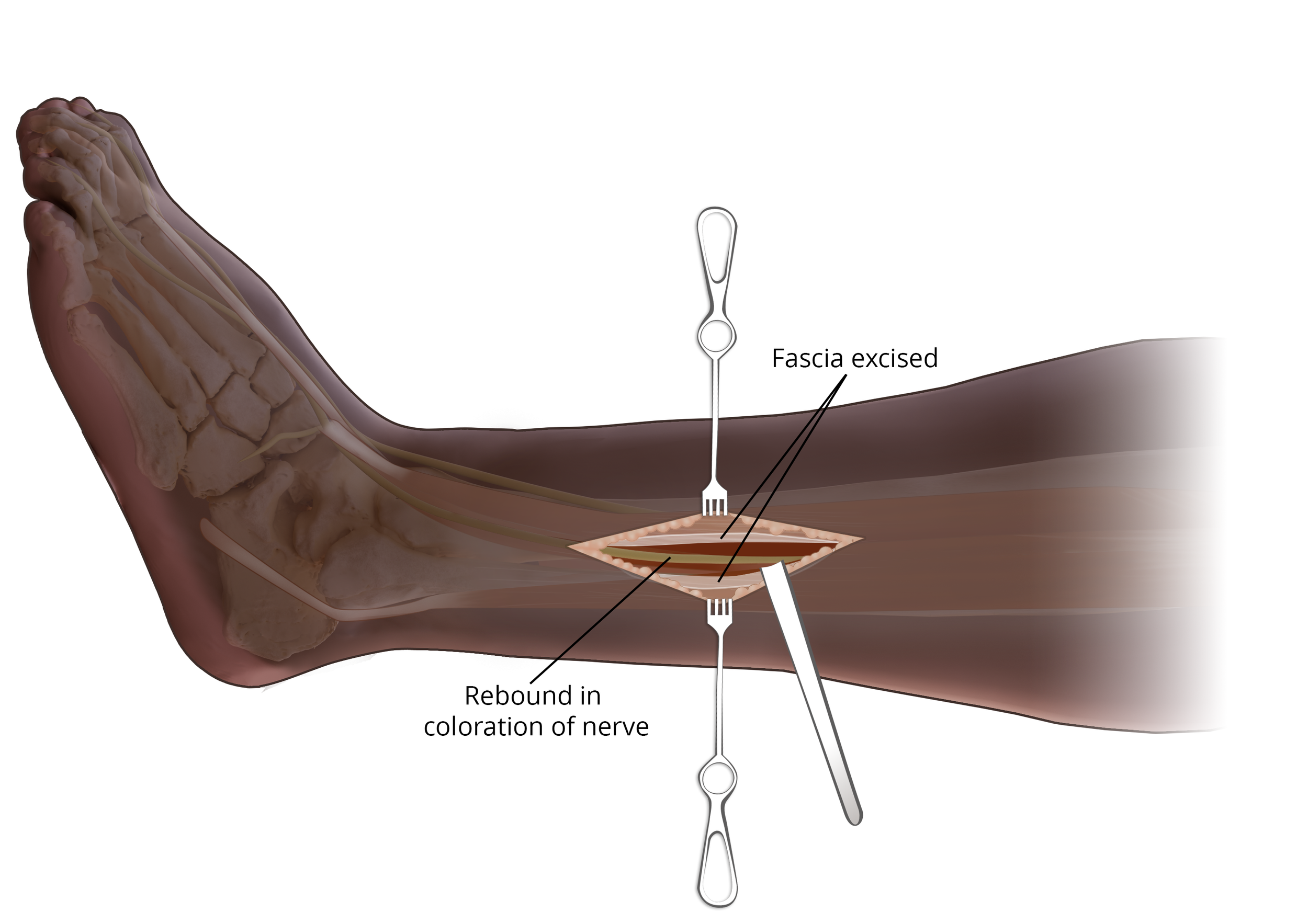  Superficial Peroneal Nerve Release 

 

 Contusion sustained during a motor vehicle accident that injured nerves of the left foot and required subsequent nerve releases.  Released nerve, created with CT data and Photoshop 