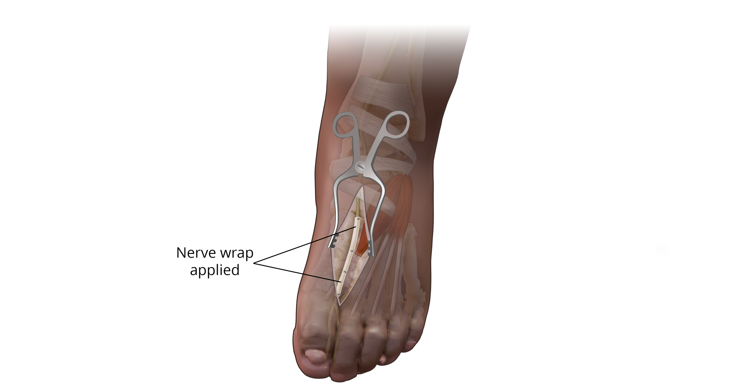  Deep Peroneal Nerve Release with Wrap 

 

 Nerve wrap applied to deep peroneal nerve, created with CT data and Photoshop 