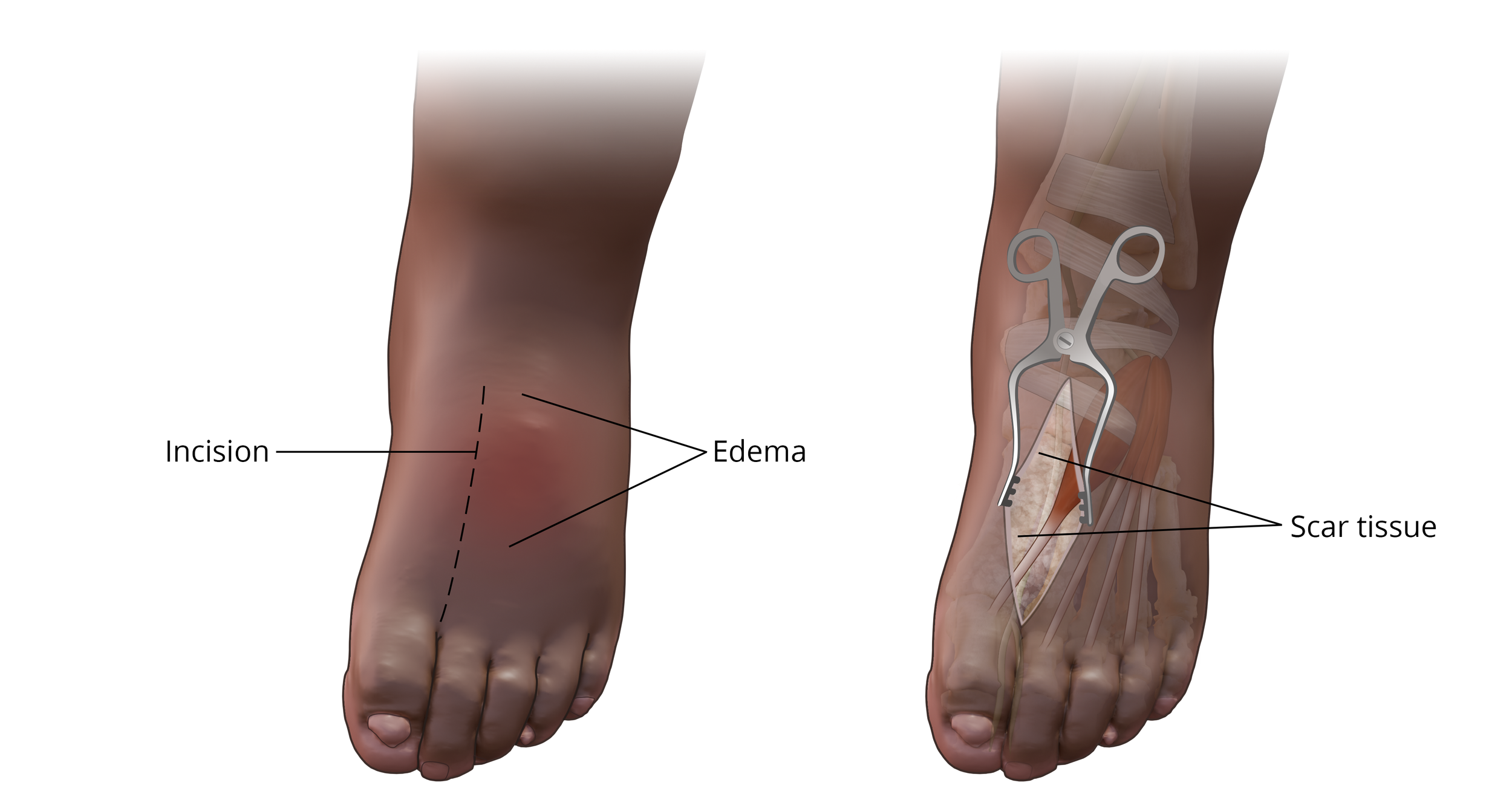  Deep Peroneal Nerve Release with Wrap 

 

 Incision and exposure, created with CT data and Photoshop 