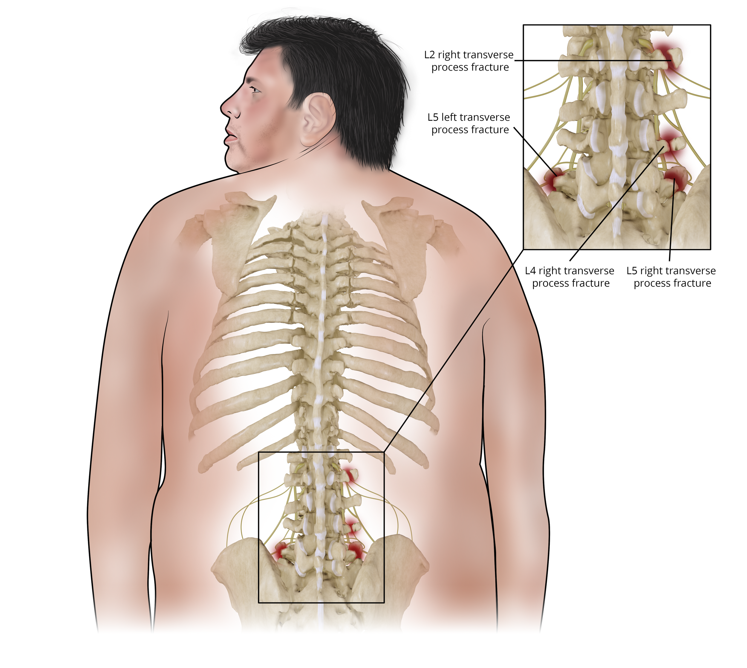  Transverse Process Fractures 
 

 Injuries sustained while unloading a tractor trailer.  