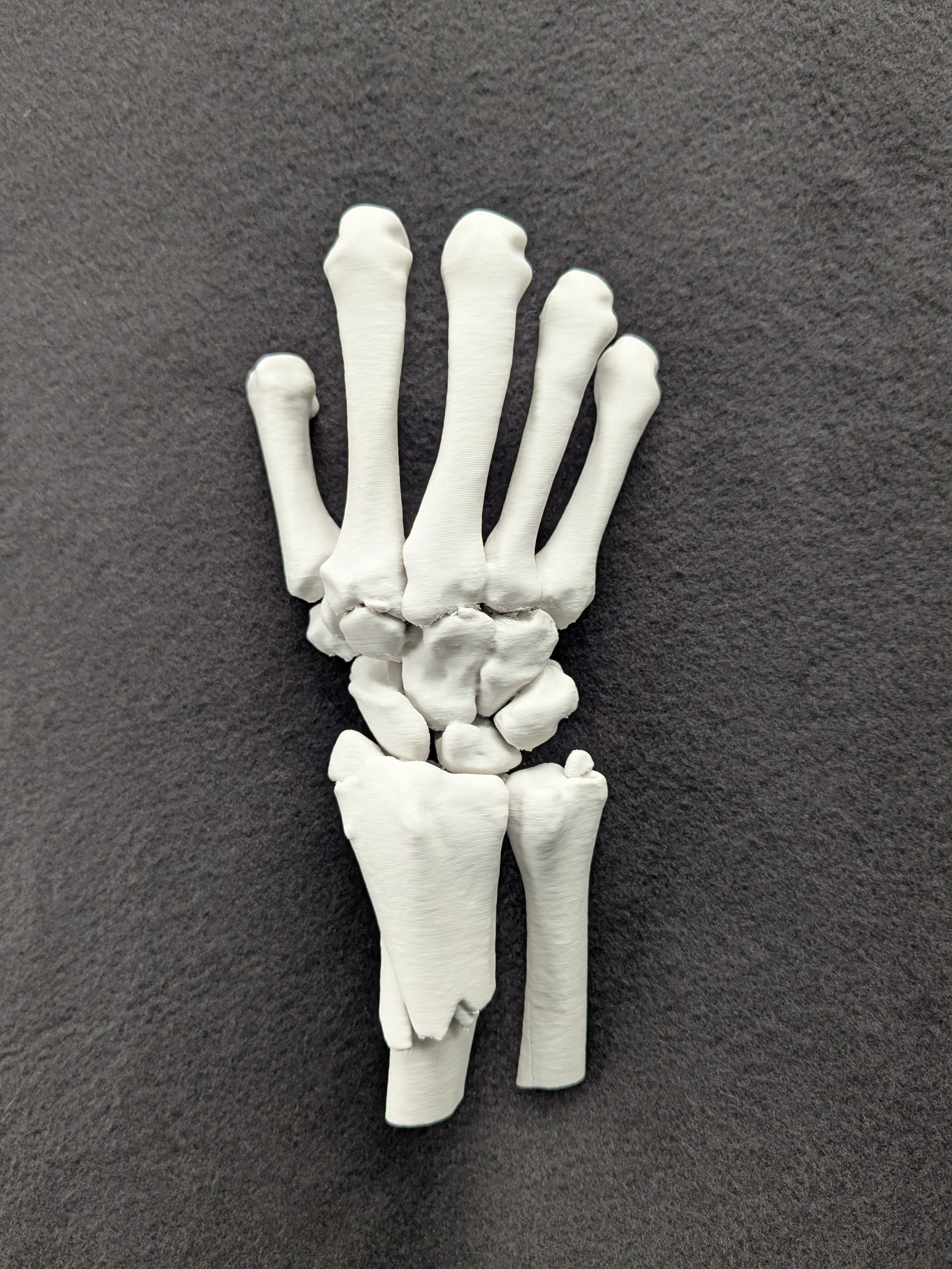  3D Printed Wrist Fracture 
