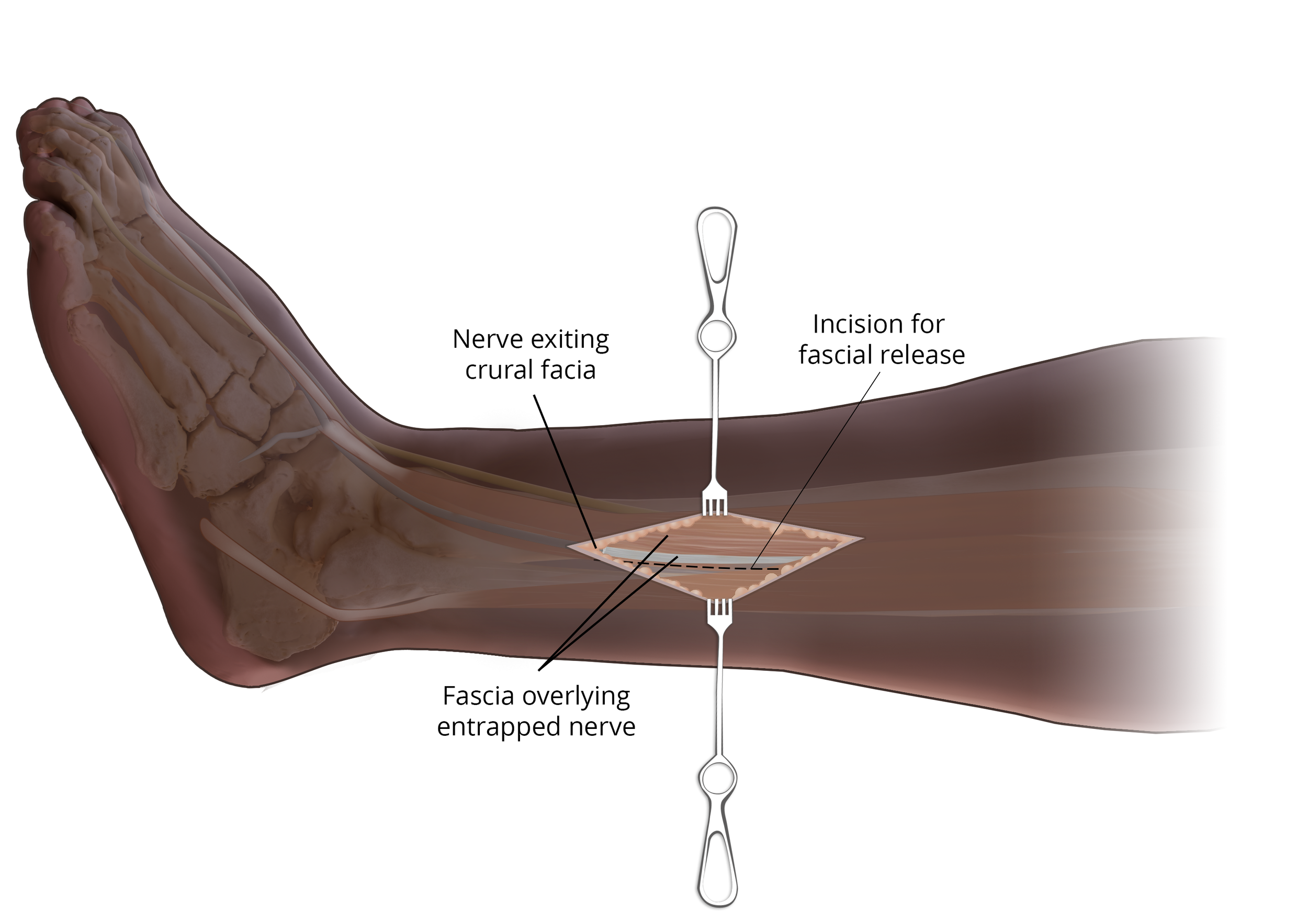  Superficial Peroneal Nerve Release 

 

 Contusion sustained during a motor vehicle accident that injured nerves of the left foot and required subsequent nerve releases.  Fascial exposure, created with CT data and Photoshop 