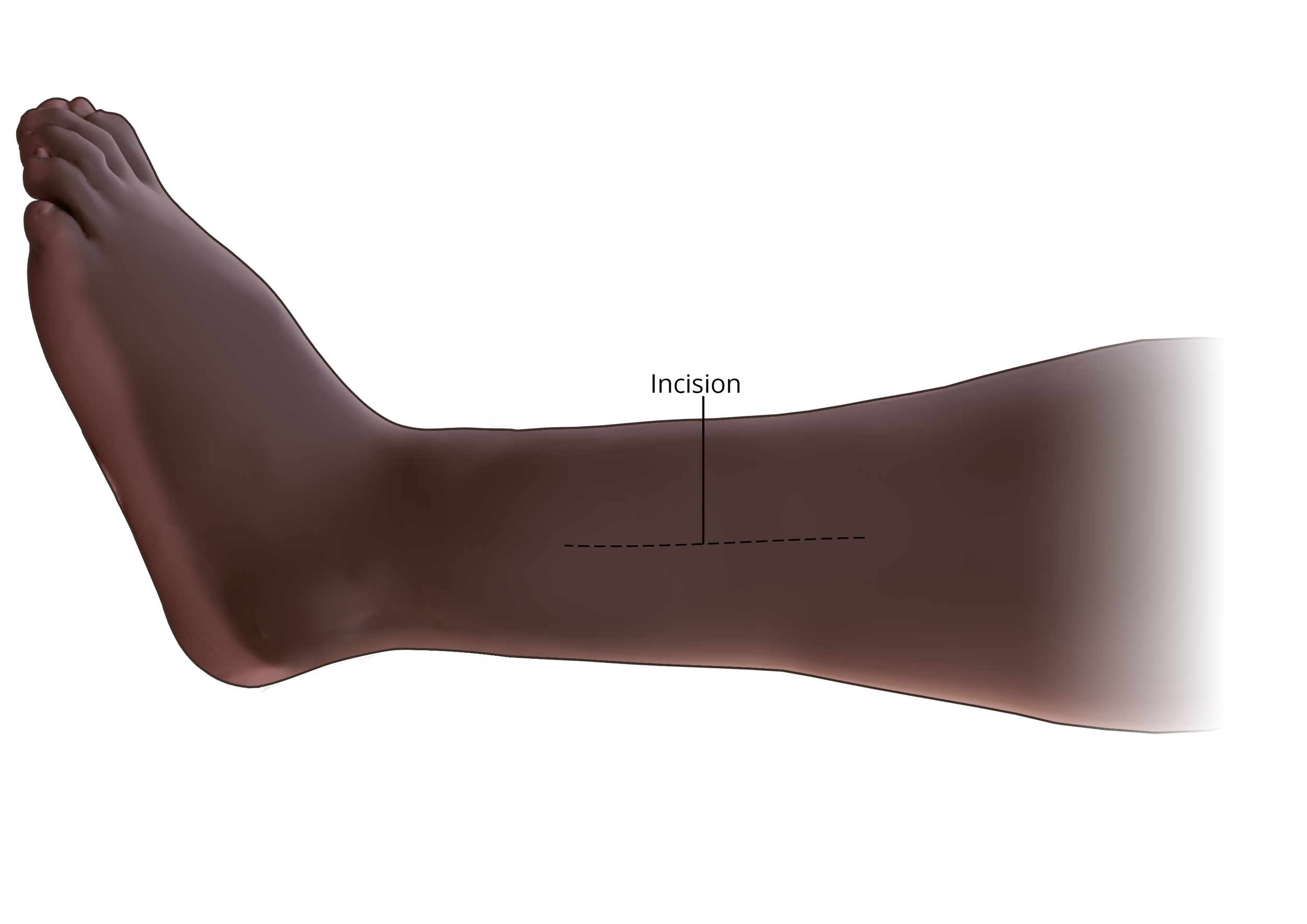  Superficial Peroneal Nerve Release 

 

 Contusion sustained during a motor vehicle accident that injured nerves of the left foot and required subsequent nerve releases.  Incision, created with CT data and Photoshop 