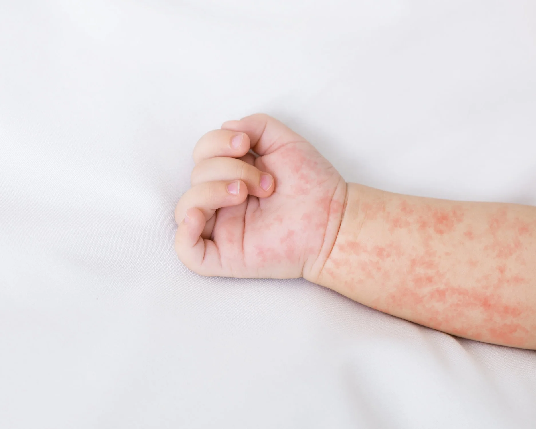 hand-of-newborn-baby-with-measles-rash-on-white-Z7NQAHG.jpg