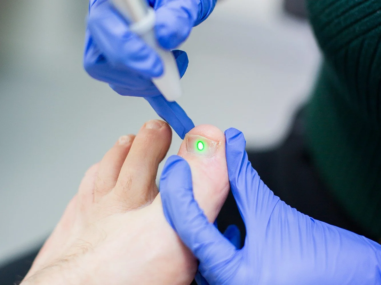 Why Laser Is Currently The Best Fungal Nail Treatment