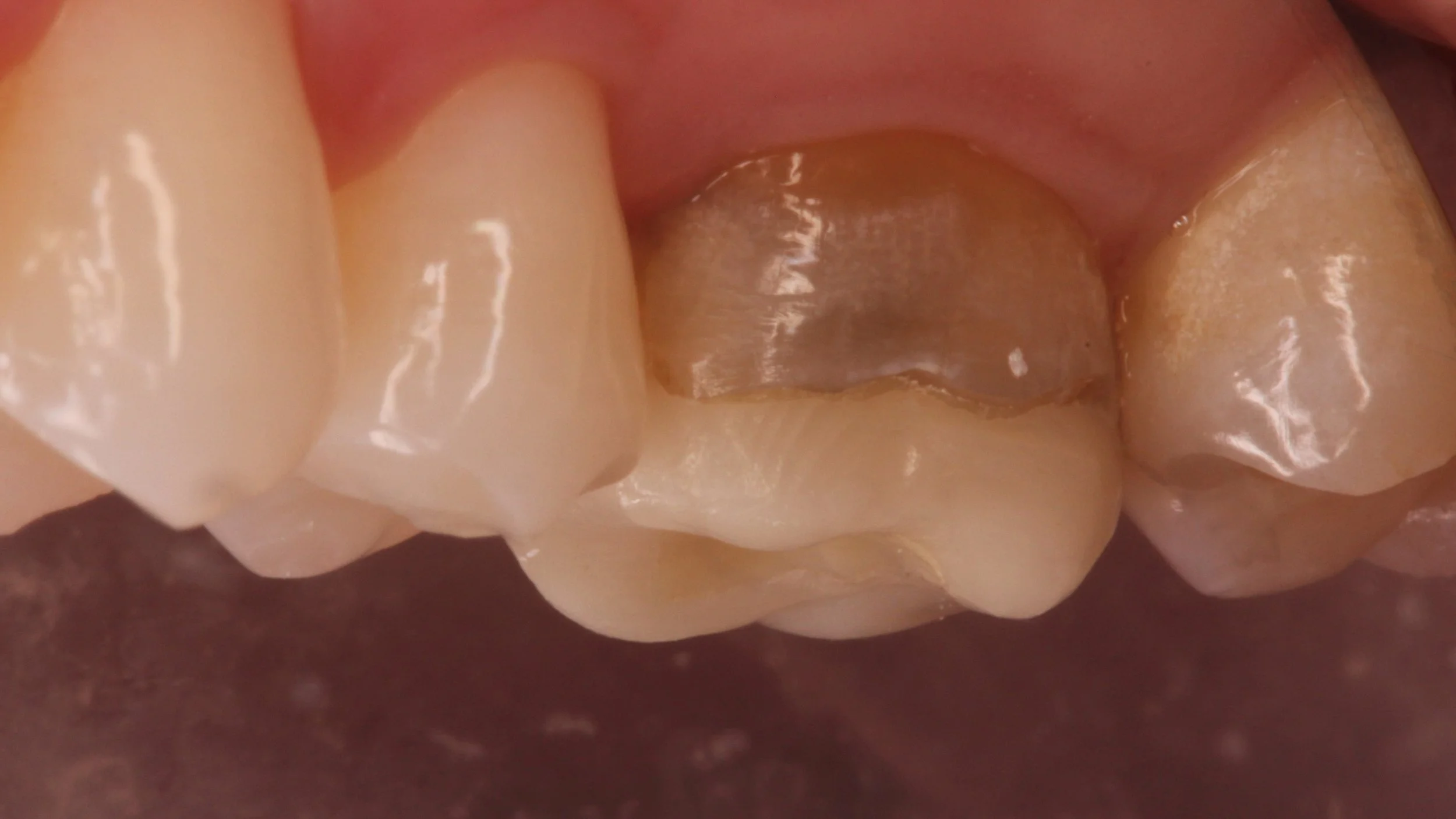 CEREC Crowns Point Loma San Diego — Harbor Dental