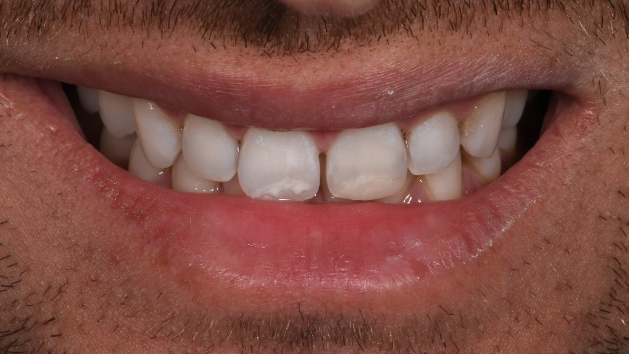 San Diego Porcelain Veneers Harbor Dental Point Loma — Harbor Dental