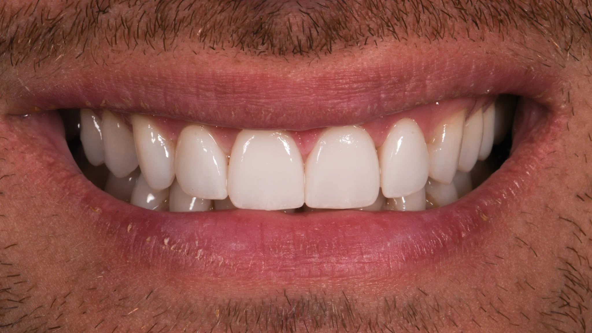 San Diego Porcelain Veneers Harbor Dental Point Loma — Harbor Dental
