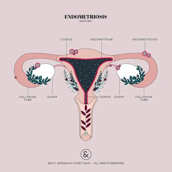 endometriosis.jpg