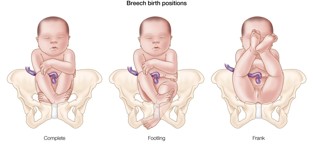 Breech-birth-(1).jpg