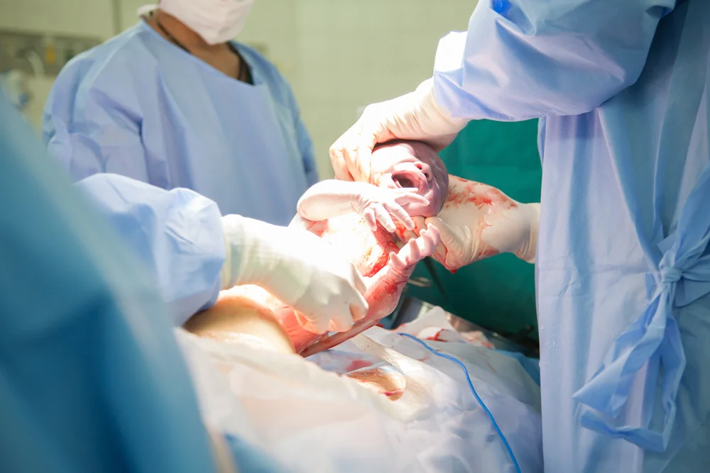 Caesarean-4.jpg