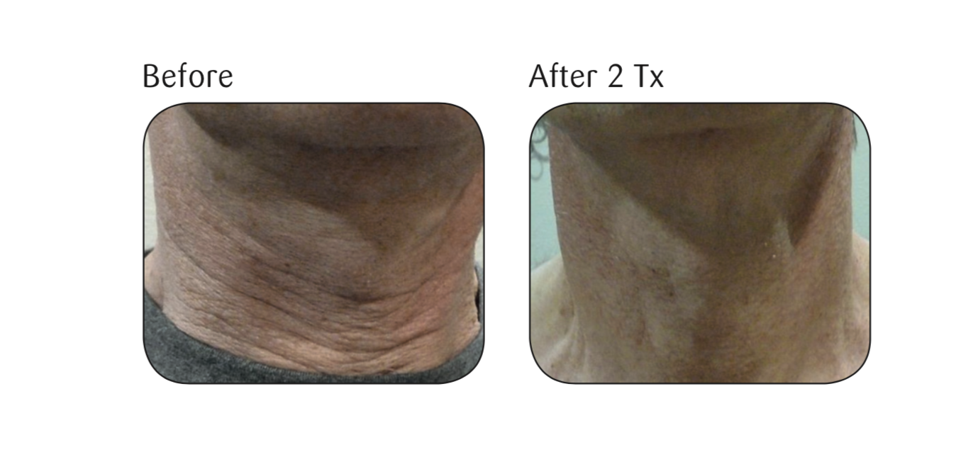 Before and after two Viora Skin Tightening (V-ST) treatments.