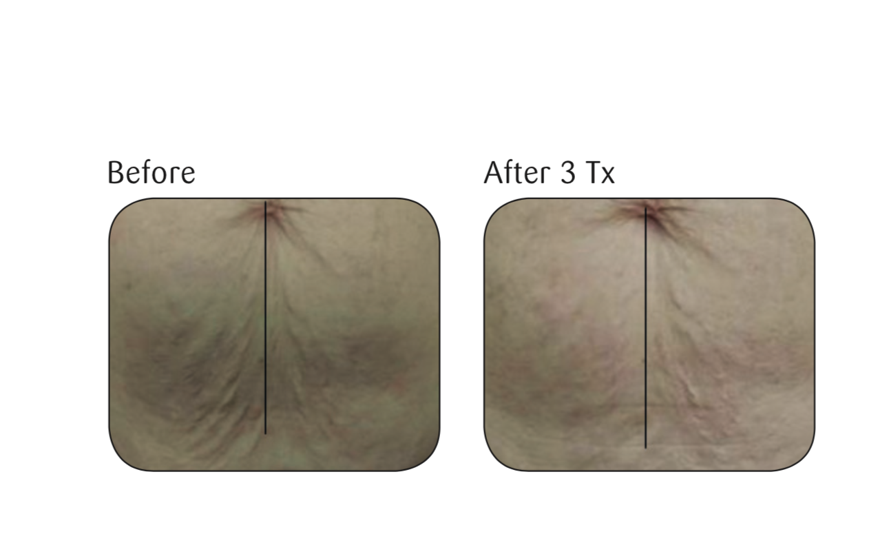 Before and after three skin tightening treatments using the Viora Skin Tightening (V-ST) procedure.