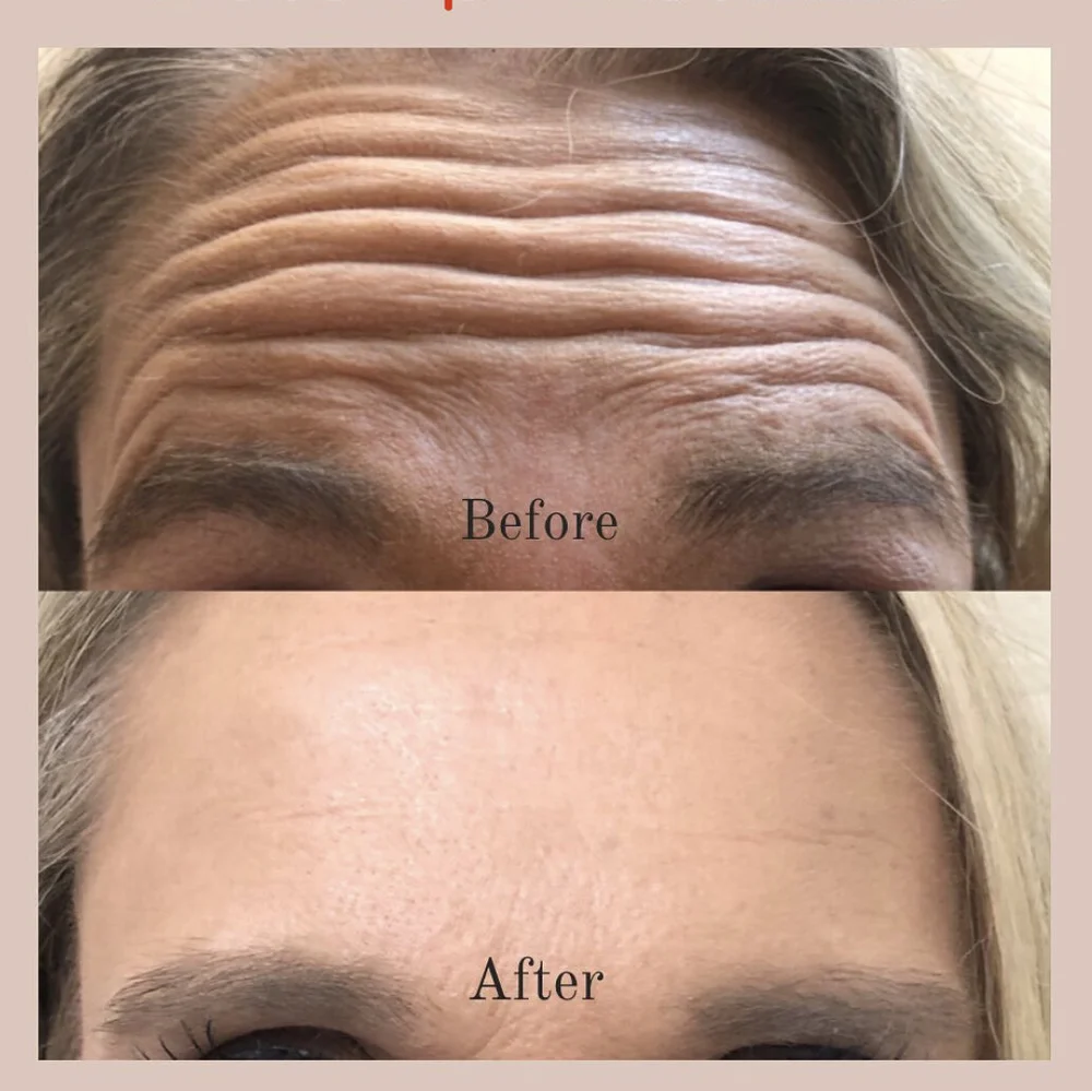 Dermal fillers and Botox in Knoxville, TN — Old City MedSpa