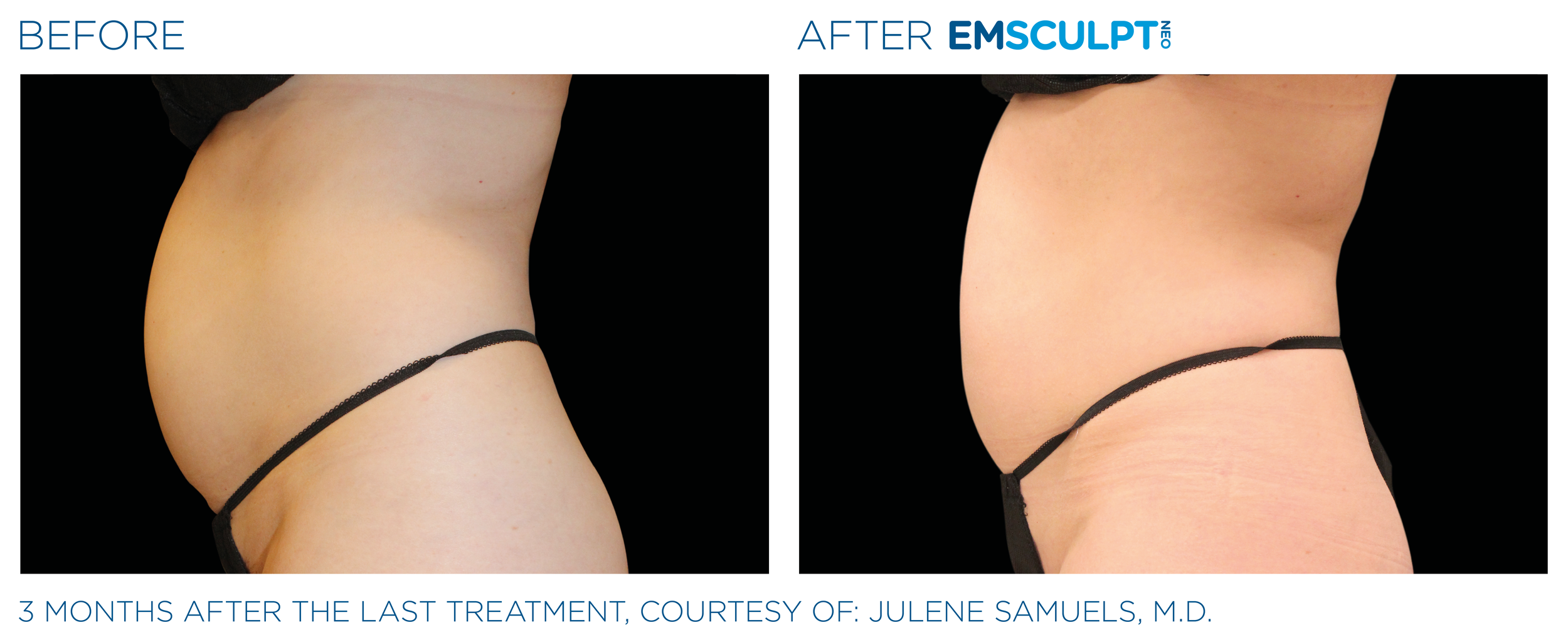 Emsculpt_neo_PIC_Ba-card-female-abdomen-007_ENUS100.png