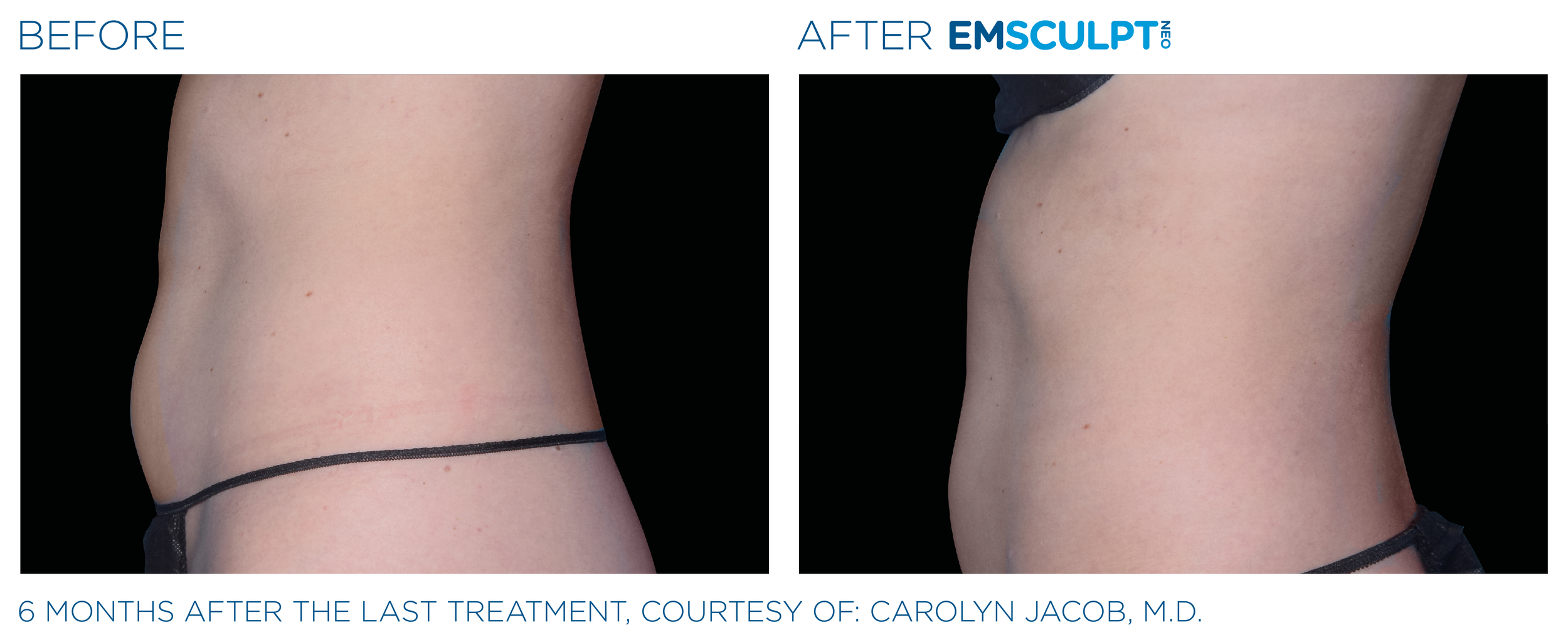 Emsculpt_neo_PIC_Ba-card-male-abdomen-042_ENUS100.png