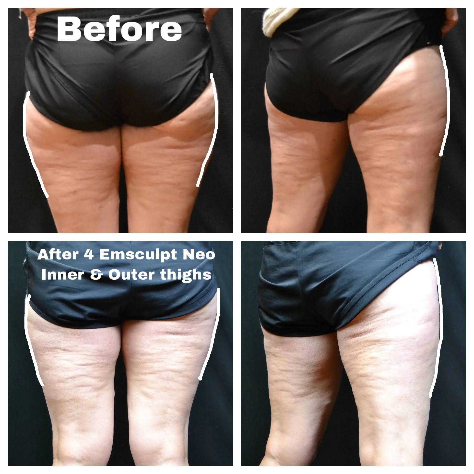 EMSCUPLT Neo Knoxville TN Old City MedSpa