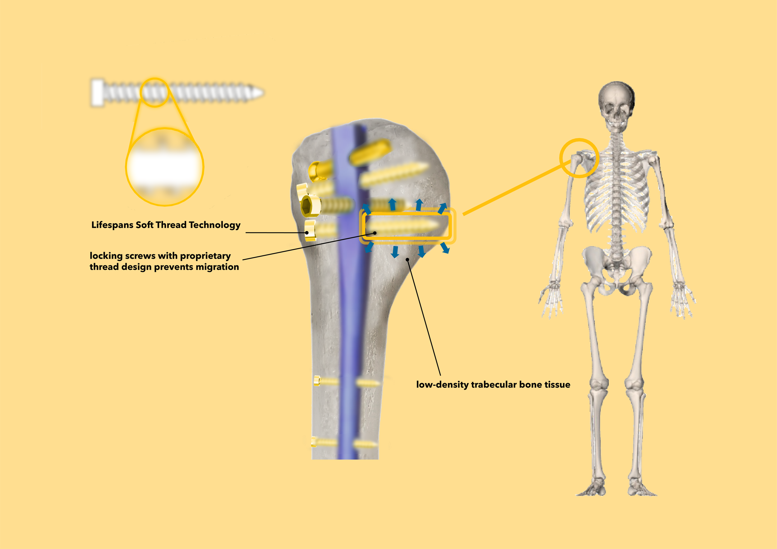Shoulder Implant-blur.png