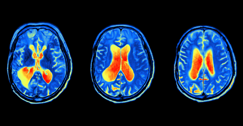 Functional MRI imaging, or fMRI, can detect changes in brain activity based on blood flow in the brain, and is becoming a powerful tool for visually describing the variations in brain function. Credit: PsychologySoftwareTools