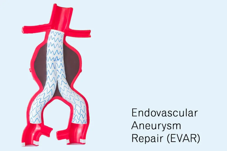 Understanding The Basics Of Aneurysms Vascular Surgery Specialist 