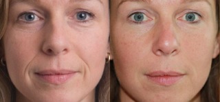 dermal-fillers-before-after.jpeg