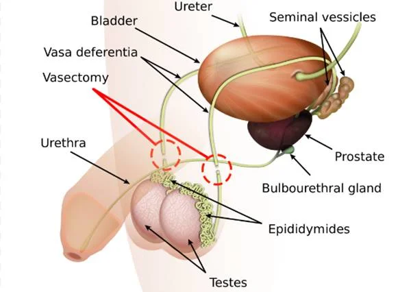 How do we ensure a successful vasectomy?