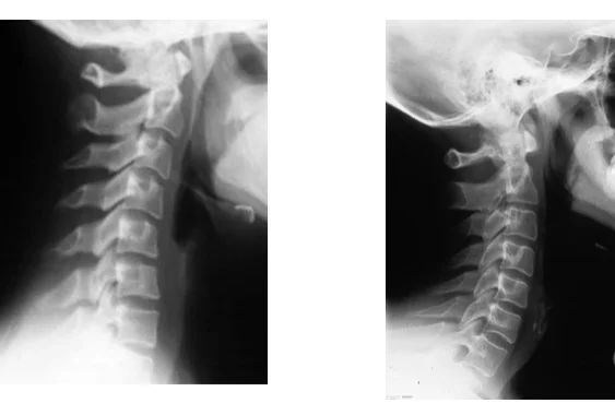 Restoration-Family-Chiropractic-cervical-xray.jpg