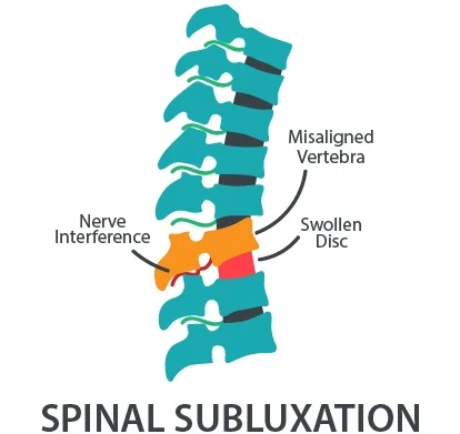 spine-subluxation.jpg