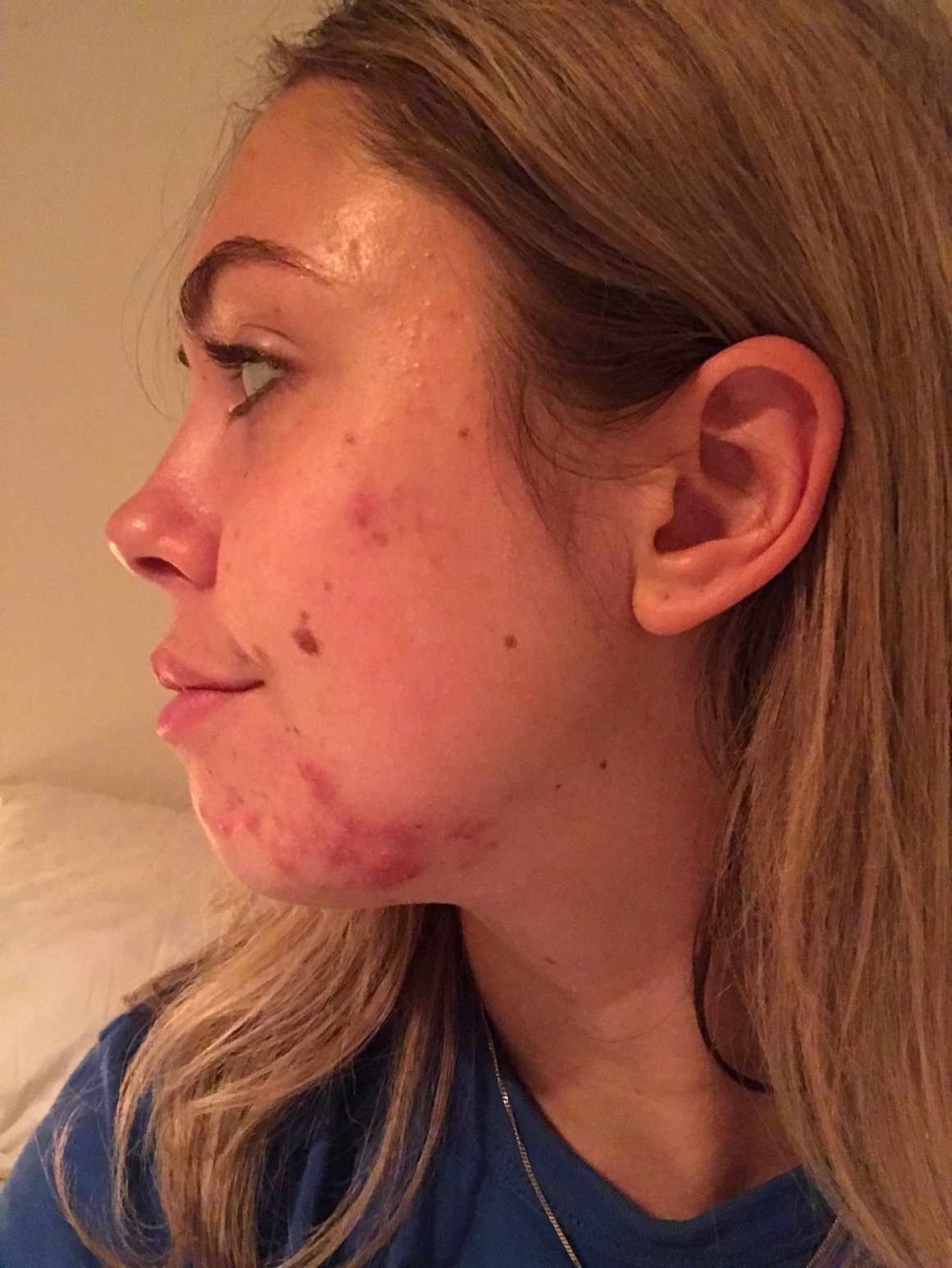 My Hormonal Acne Journey 2