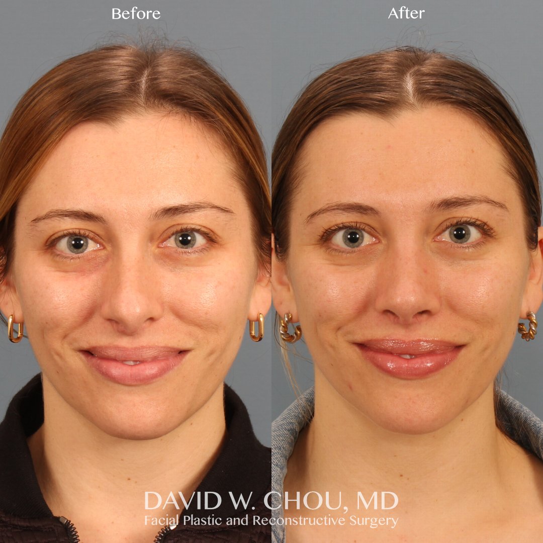 My patient can't stop smiling 6 months after rhinoplasty to correct a severely deviated caudal septum and refine some of the contours on her already beautiful nose.

Swipe for more views and nasal breathing and cosmesis scores ➡➡➡

NOSE 85 -&gt; 0
SC