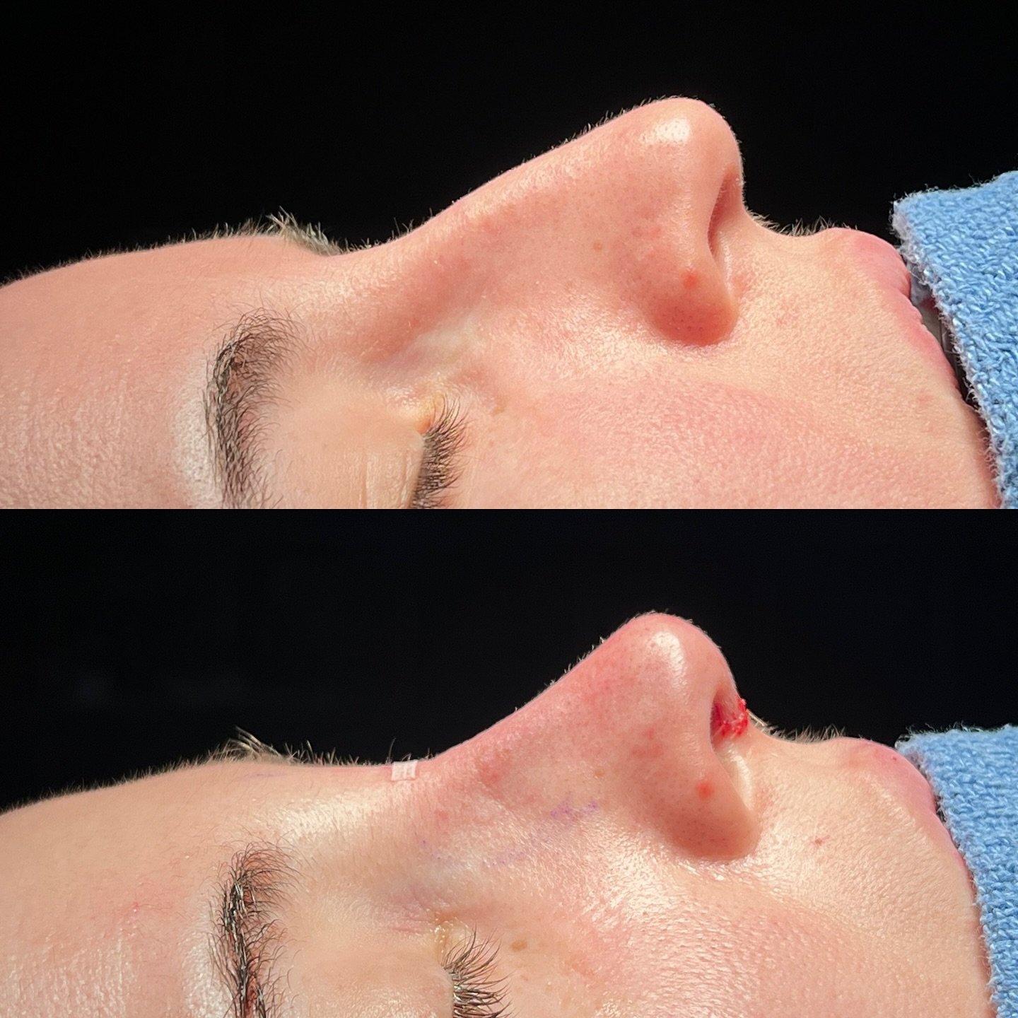 Hybrid dorsal preservation and structural rhinoplasty immediately before and after surgery to address the dorsal hump, droopy tip, and collapsed cartilages in the nose.

Photos shared with patient permission. Do not reproduce.

#rhinoplasty #rhinopla