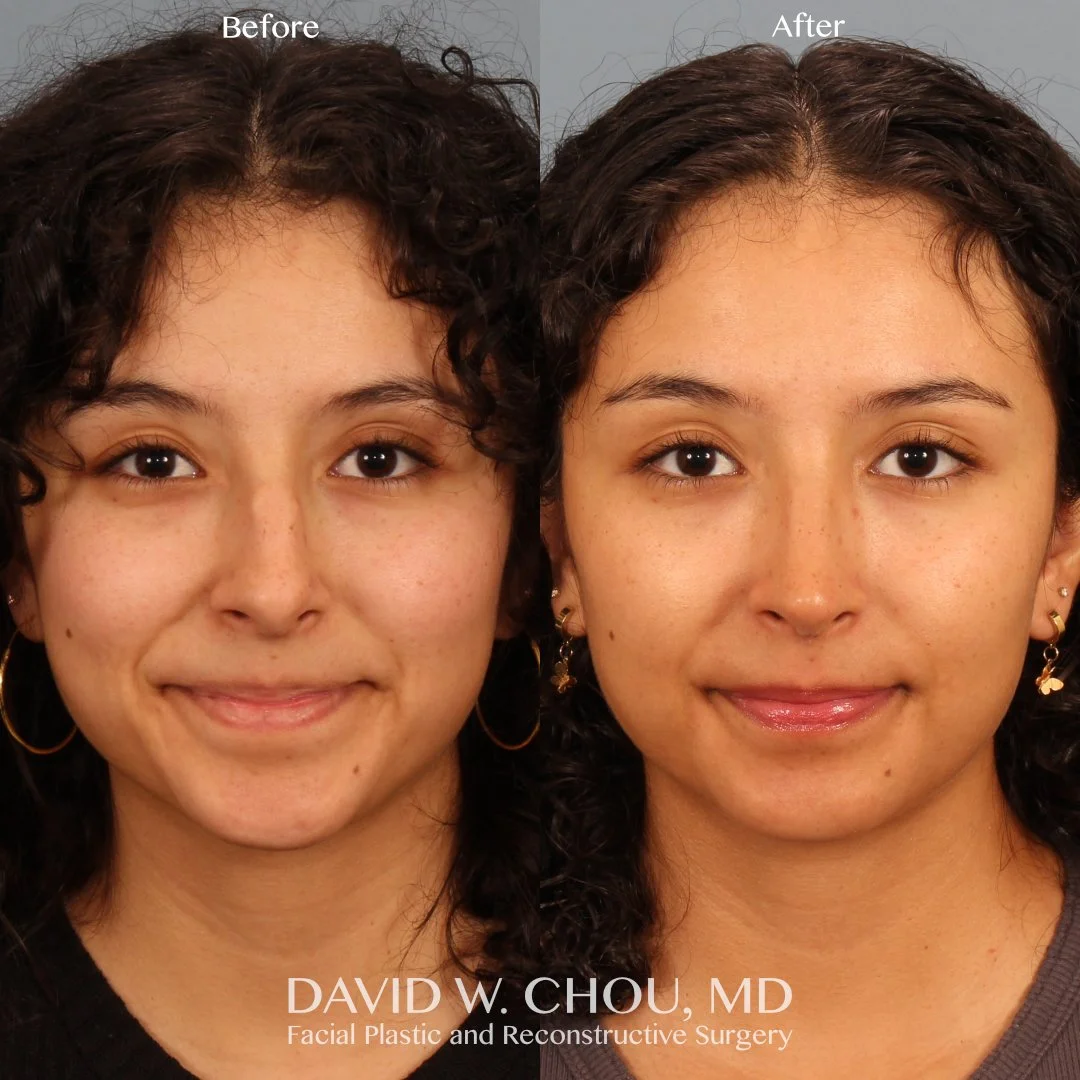 4-month postop update for my beautiful patient who underwent rhinoplasty to straighten the nose, reduce the dorsal hump, refine the tip, and improve her breathing. Loving her early results from all angles - natural, elegant, and functional.

Swipe fo