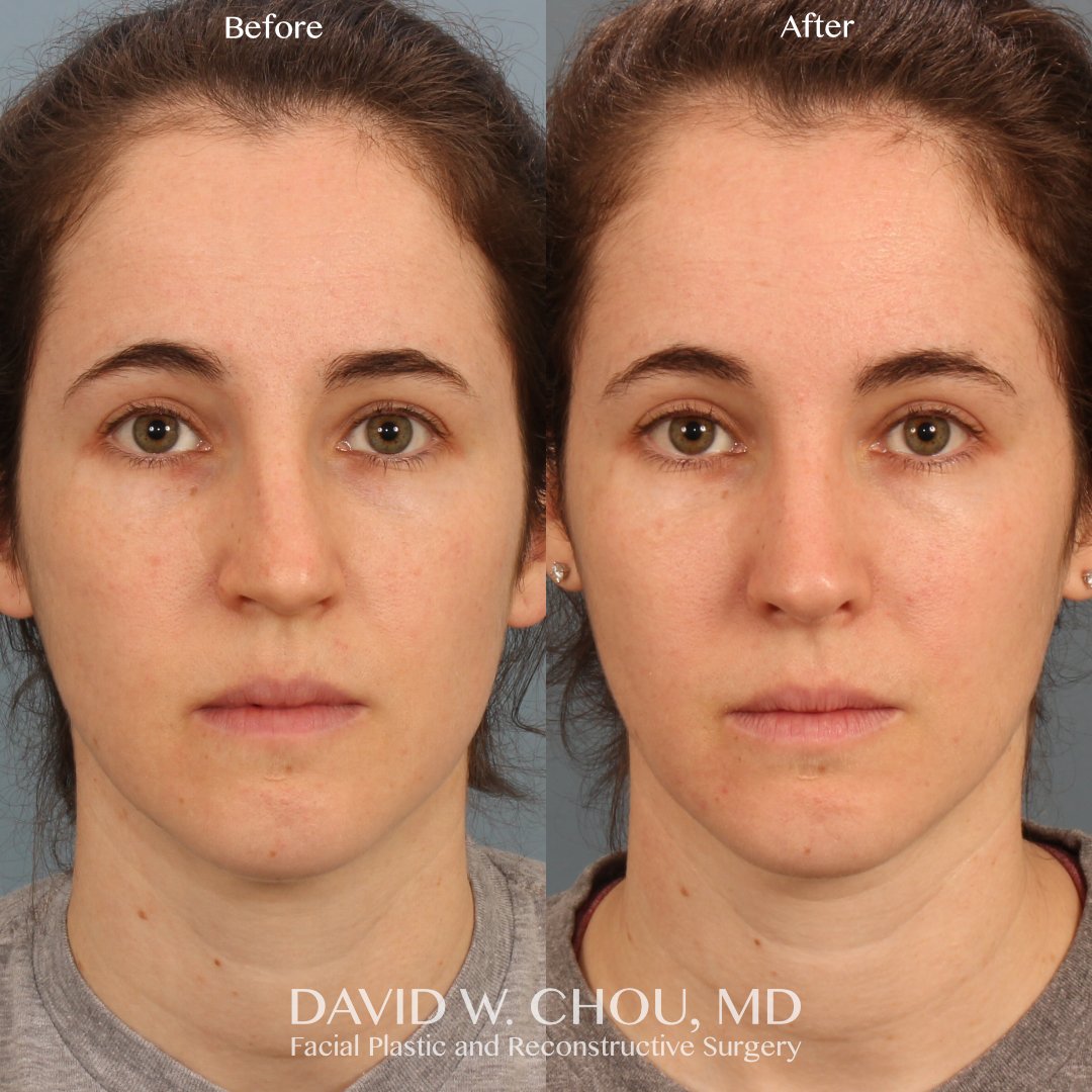 My awesome patient is shown 5 months out from a primary dorsal preservation rhinoplasty and we're happy to see that her nasal balance and breathing are much improved!

NOSE score 45 -&gt; 10
SCHNOS 11 -&gt; 2

Swipe for more views ➡➡➡

Photos shared 