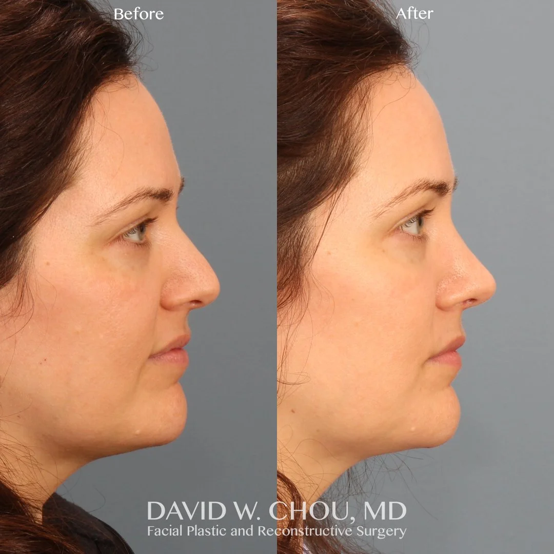 I saw this super sweet patient of mine nearly 5 months after rhinoplasty to improve her nasal breathing and make some subtle refinements to her already pretty nose. Check out her base view to see how much better supported her nostrils are while breat