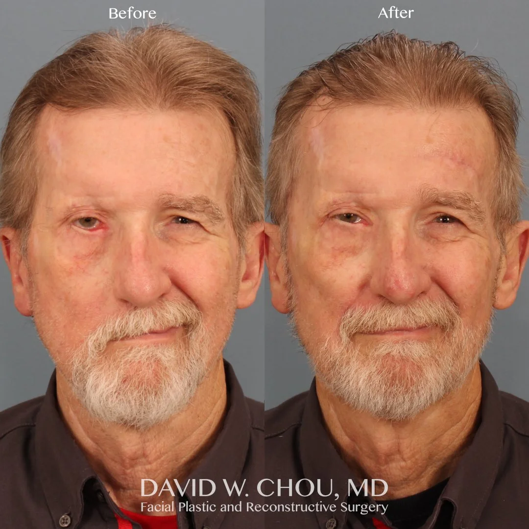 This resilient gentleman suffered right facial paralysis as an after-effect of multiple surgical and medical treatments for a cancer that invaded his facial nerve.

Here he is 3.5 months after I performed his most recent surgery to improve his facial