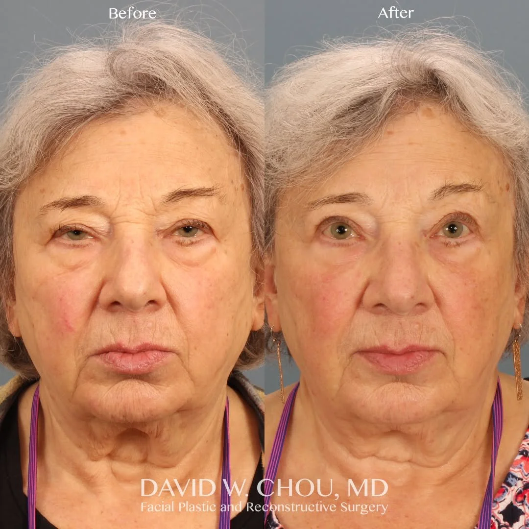 5 months after an upper blepharoplasty and ptosis repair to help improve this patient's heavy, droopy eyelids. Now she's seeing much better and feeling great!

Swipe for close-ups ➡➡➡

Photos shared with patient permission. Do not reproduce.

#blepha