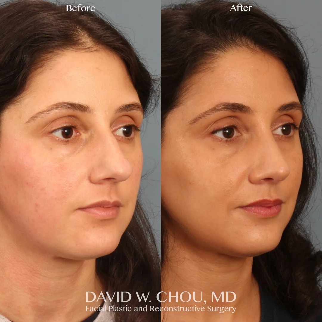 Very happy to share these updated photos of my lovely patient who underwent a primary open septorhinoplasty 9 months ago. She's healed up incredibly well and can breathe significantly better than ever before!

A lot of patients ask about the scar bet