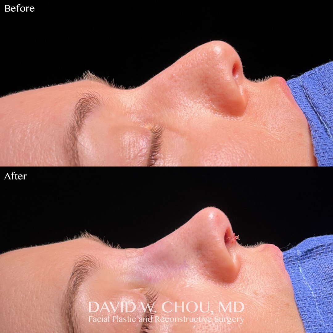 Preservation rhinoplasty on the table. Gentle dorsal reduction, axis realignment, tip support and rotation.

Photos shared with patient permission. Do not reproduce.

#rhinoplasty #rhinoplastybeforeandafter #nosejob #nosejobbeforeandafter #plasticsur