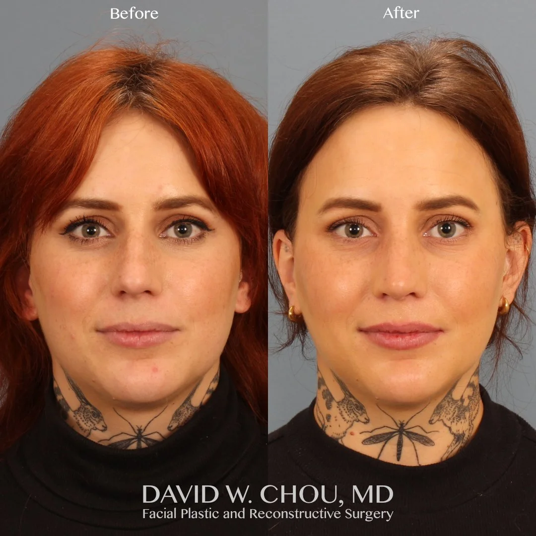 My awesome patient Allie is 3 months out from a secondary rhinoplasty with rib and fascia to improve the contour and straightness of her nose, reduce her dorsal hump, and most importantly improve her breathing.

We went for a natural and not over-don