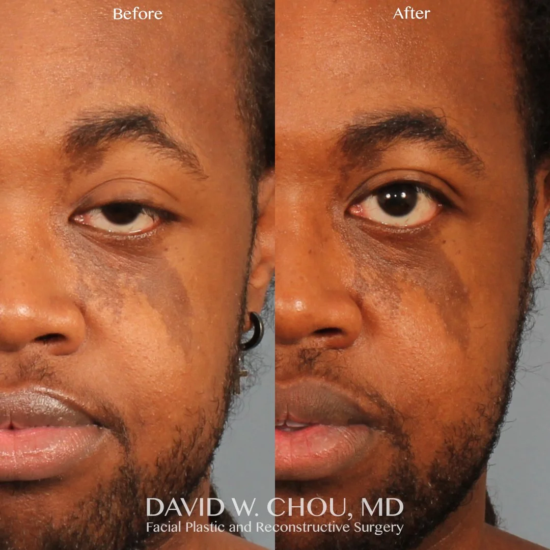 side by side 13 mo postop ptosis repair.jpg