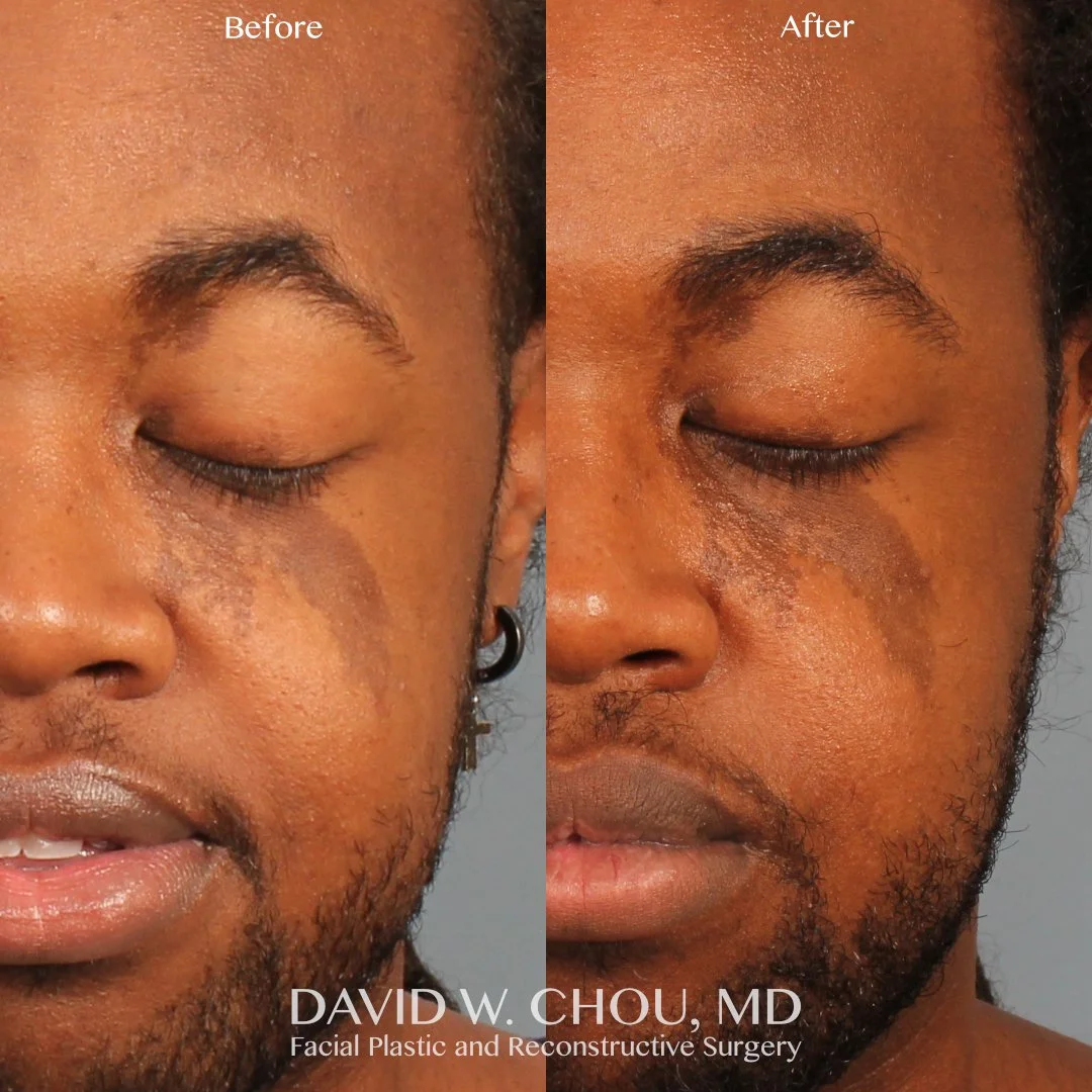 side by side 13 mo postop ptosis repair eyes closed.jpg