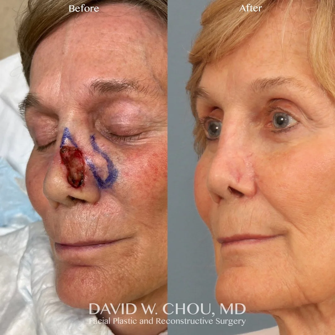 left nasal mohs recon before after.jpg