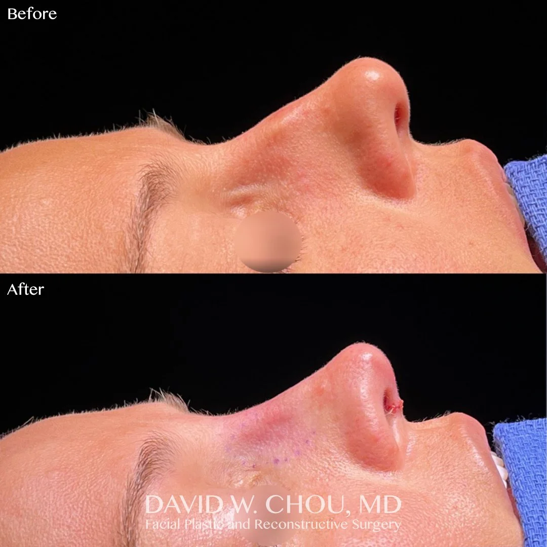 Smoother contours at the nasal transition zones, refined tip definition, and improved nostril patency after this rhinoplasty.

Swipe for more views ➡➡➡

Eyes blurred per patient request. Photos shared with patient permission. Do not reproduce.

#rhin