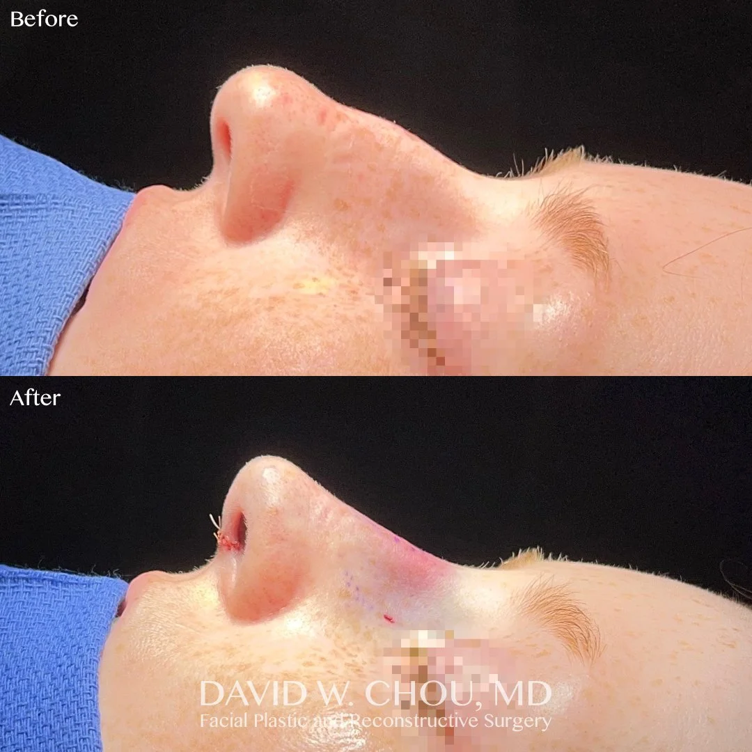 Rhinoplasty to straighten the nasal profile, soften the dorsal aesthetic lines, refine the tip, and improve breathing.

Swipe for more views ➡➡➡

Photos shared with patient permission. Do not reproduce.

#rhinoplasty #rhinoplastybeforeandafter #nosej
